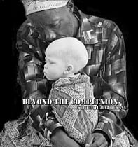 Razzismo africani, persecuzione albini Albinismo_razza_nera_wikipedia2-1